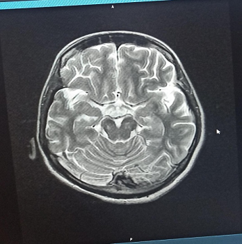 Figure 2 : MRI spine showing Schmorl’s node at L3 with disc bulges at L4-L5 and L5-S1 indenting the thecal sac and causing bilateral foraminal compromise Figure 2 : MRI spine showing Schmorl’s node at L3 with disc bulges at L4-L5 and L5-S1 indenting the thecal sac and causing bilateral foraminal compromise
