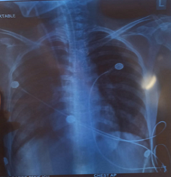 Figure 3 : Chest X-ray (PA view) showing bilateral patchy heterogeneous opacities, most prominent in mid and lower lung zones, suggestive of possible consolidation Figure 3 : Chest X-ray (PA view) showing bilateral patchy heterogeneous opacities, most prominent in mid and lower lung zones, suggestive of possible consolidation