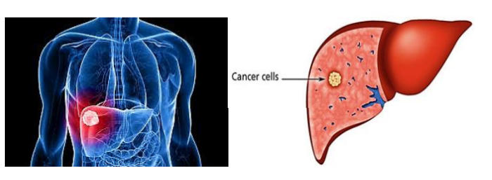 Figure 1: Ultrasound Image for Liver Malignancy Cell Identification[1]