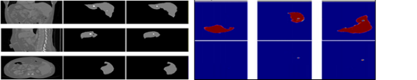 Figure 6 : Three-dimensional and fully convolutional neural networks are used to segment the liver and liver tumours.[1]